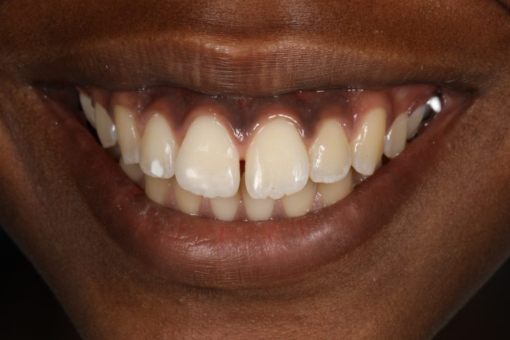 Bonded Tooth - Chipped Tooth Correction in Cincinnati